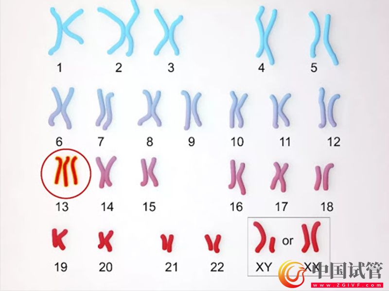 唐氏综合征21号异常染色体引发的危害(图1)