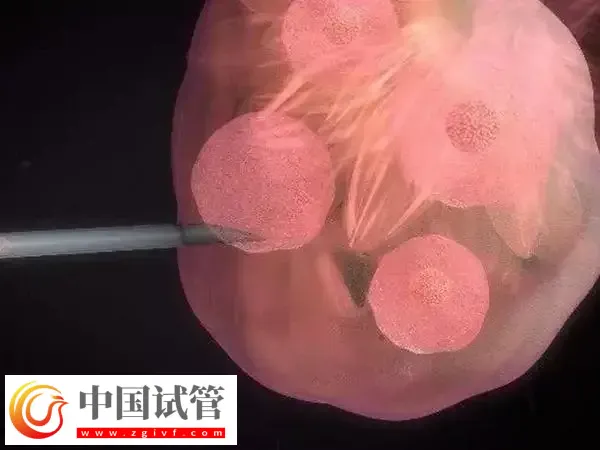 俄罗斯取卵有什么风险(图1)