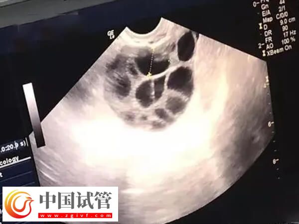 为什么打了促排针卵泡还长这么慢(图1)