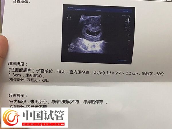 试管胎停育的前兆反应有哪些(图1)