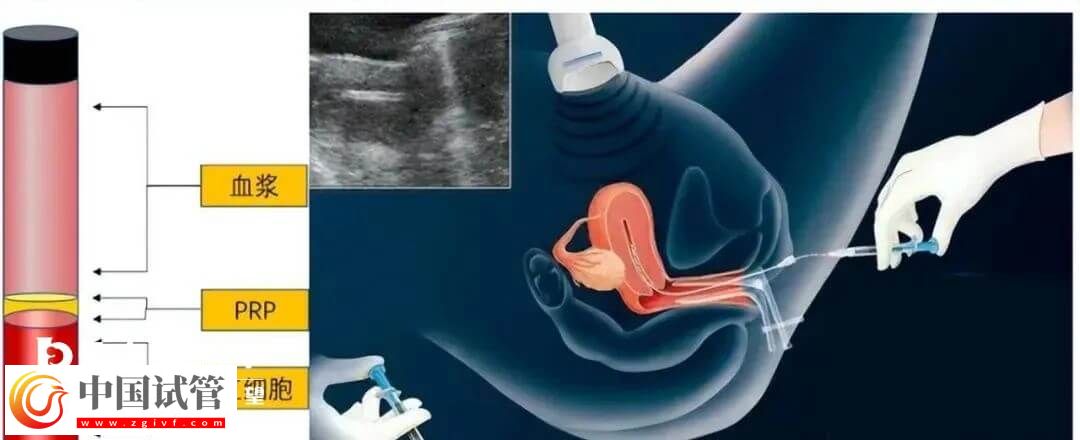宫腔灌注具体的操作流程是怎么样的？需要几分钟完成？(图1)