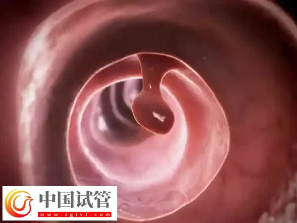 鞍型子宫做试管成功率高不高(图2)