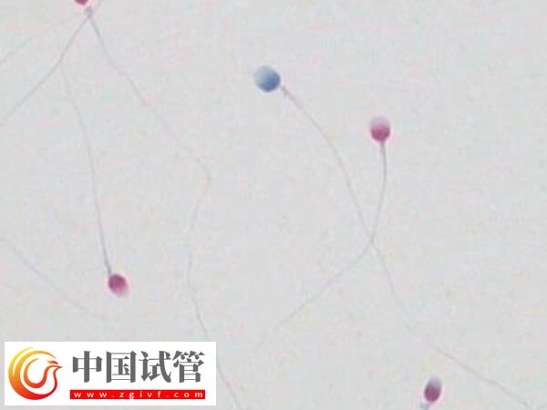 精子碎片报告是什么样的(图1)