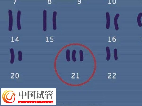 22号染色体异常还能不能要孩子(图2)