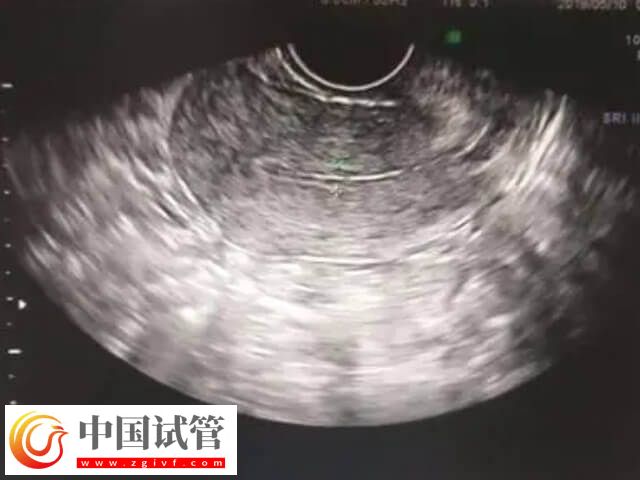 amh低于0.06还有没有卵(图2)