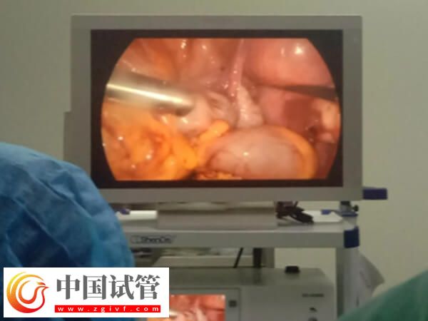 腹腔镜子宫切除手术怎么做(图5)