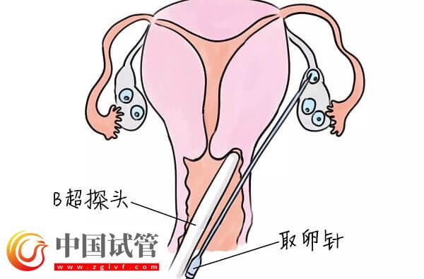 试管婴儿中用果纳芬好不好(图3)