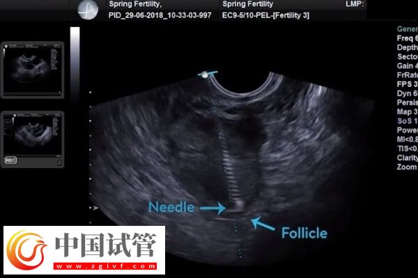 做试管婴儿取卵后有腹水怎么办(图1)