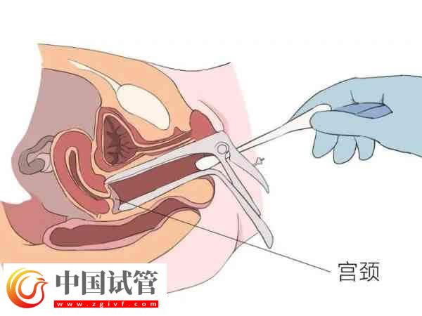 宫腔粘连是怎么引起的(图1)