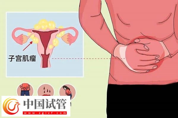 子宫肌瘤是什么原因导致的？专家解读子宫肌瘤的原因(图1)