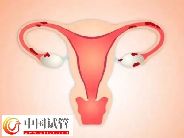 腔粘连不治会有什么后果(图1)