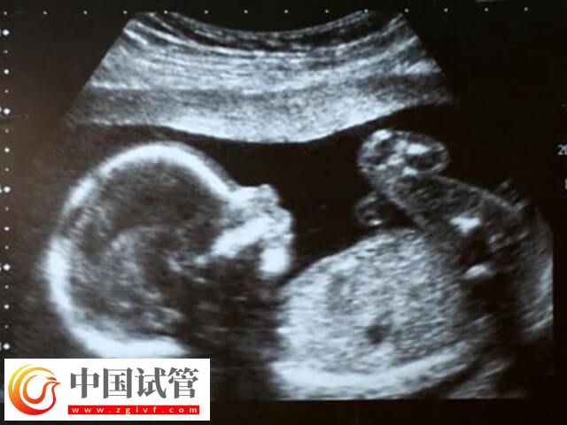 试管一超二超三超检查什么(图1) 试管一超二超三超检查什么(图1)