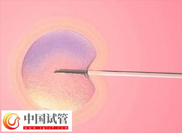 取卵同时能不能穿刺囊肿(图2) 取卵同时能不能穿刺囊肿(图2)