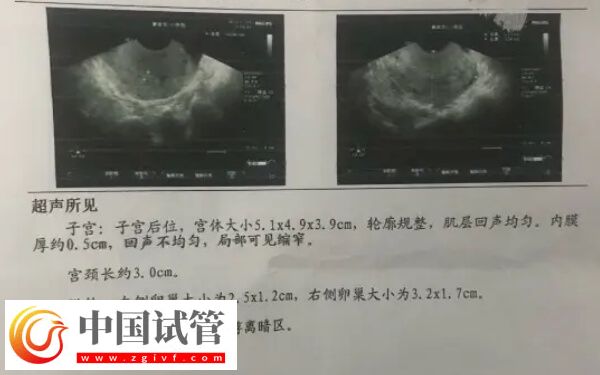 试管移植前内膜下降怎么回事(图2)