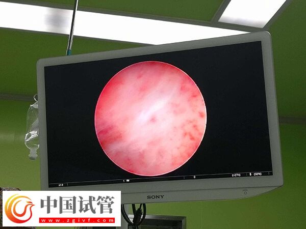 试管移植前内膜下降怎么回事(图1)