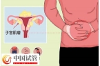 子宫肌瘤是什么原因导致的？专家解读子宫肌